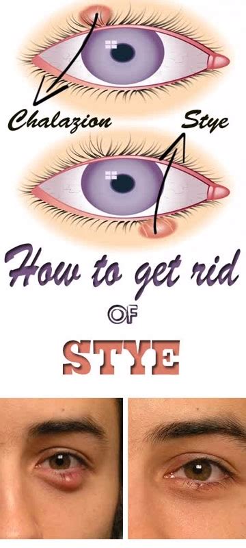 How To Get Rid Of A Stye Get Rid Of Stye Eye Stye Remedies Stye