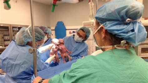 rare mono mono twins hold hands at birth cbs news