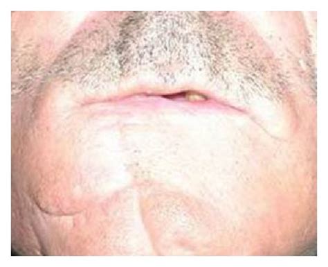 A Frontal View Of Patient With Lower Lip Squamous Cell Carcinoma B