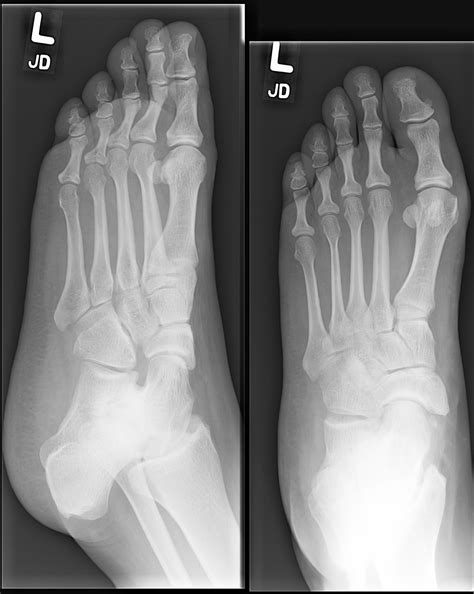 Talocalcaneal coalition | Image | Radiopaedia.org