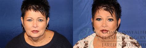 Neck Lift For Lexington And Louisville Ky Commonwealth Plastic Surgery