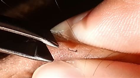 Well, dermatologist shari marchbein, notes that while bhas (commonly salicylic acid) can help banish those pesky bumps left by shaving, beating and removing ingrown hairs is tougher work. Ingrown Hair Removal - YouTube