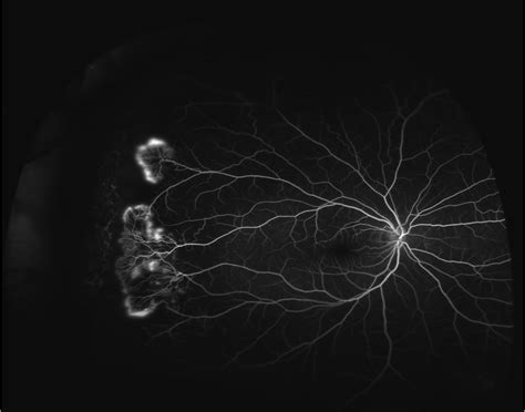 Ultra Wide Field Retinal Photography And Angiography