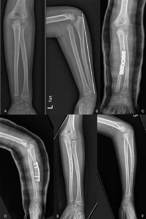 A B Preoperative Anteroposterior Ap And Lateral Radiographs Of A