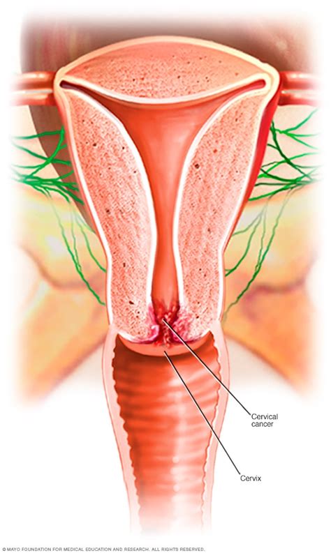 These cancerous cells can eventually spread to other tissue in the body. Cervical cancer - Symptoms and causes - Mayo Clinic