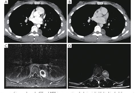 Figure 1 From Single Centre Experience In Video Assisted Thoracoscopic