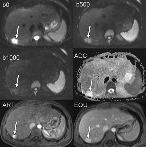 Diffusion Weighted Mr Imaging Of The Liver Radiology