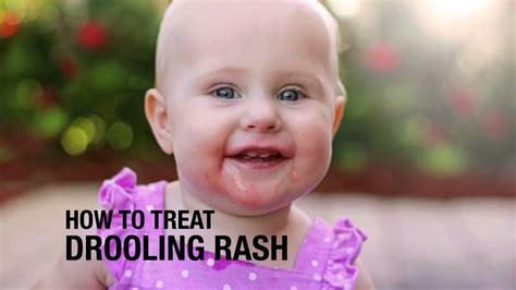 11 Natural Ways To Treat Drool Rash In Babies Teething Rash On Face