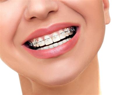 Best Benefits Of Invisible Braces