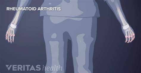 Palindromic Rheumatism Definition Defined By Arthritis Health