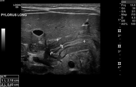 Pyloric Stenosis Ultrasound Ultrasound Ultrasound Sonography Stenosis