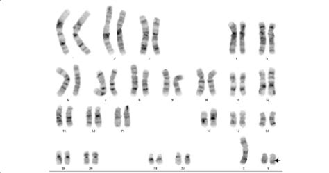 Chromosome Karyotype Analysis Of The Patient Download Scientific Diagram