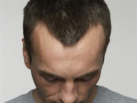 Eli5 Why Do People Go Bald In A Symmetrical Manner Rexplainlikeimfive