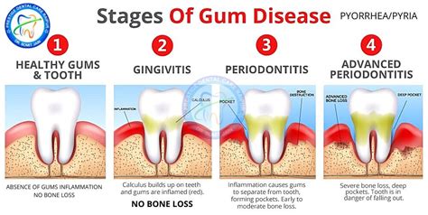 Periodontitis And Gingivitis Meaning Symptoms Tx Gum Disease