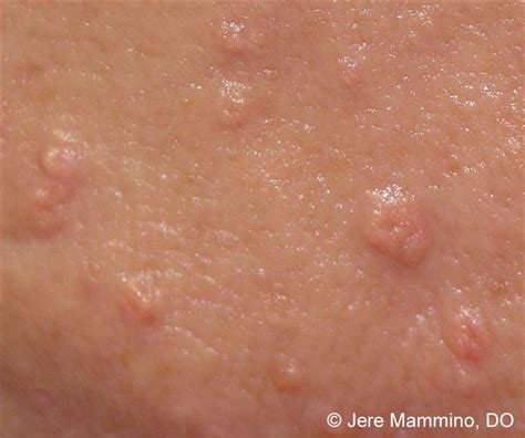 Lots Of People Have It 11 Signs Of Sebaceous Hyperplasia