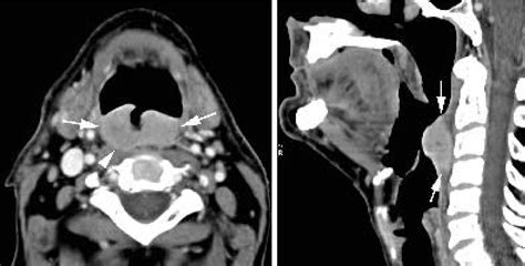 Oropharyngeal Cancer Tongue