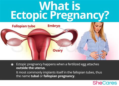 Ectopic Pregnancy Shecares