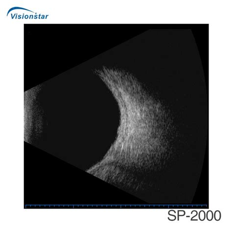 Sp 2000 China Eye Examination Portable Ultrasound Ab Scan Machine