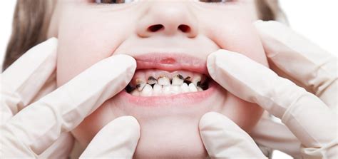 Preventive Dentistry Tips For Keeping Kids Teeth Healthy