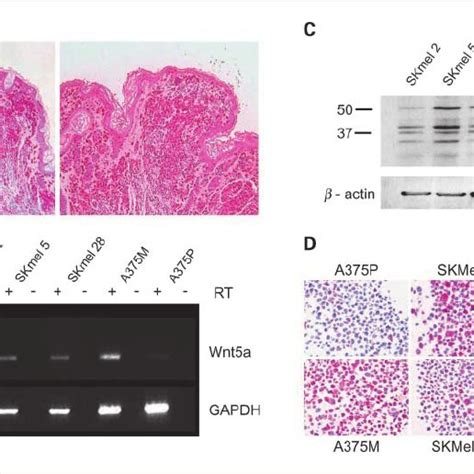 Wnt5a And P16 Ink4a Immunostaining In Common Acquired Nevi And