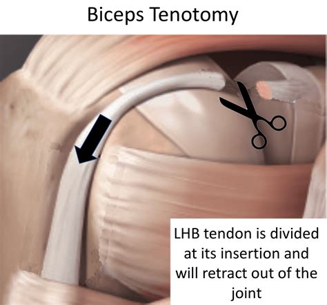 Bicep Tendonitis Treatment Chicago Biceps Tenodesis S