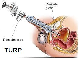 Transurethral Resection Of Prostate TURP Chin Chong Min Urology Robotic Surgery Centre