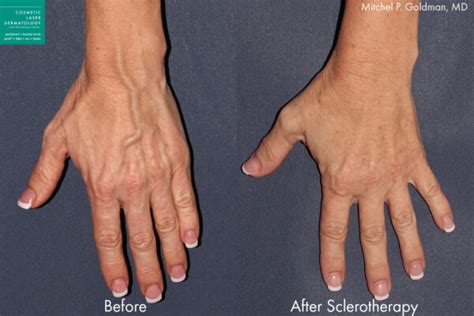 Hand Skin Rejuvenation Med Spa San Diego Ca Clderm