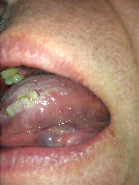 Mouth Ulcers And Thrush Diabetes Forum • The Global Diabetes Community