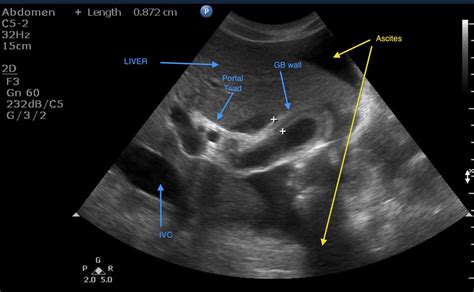 Gallbladder Wall Thickening Cholecystitis Ultrasound Cases Info