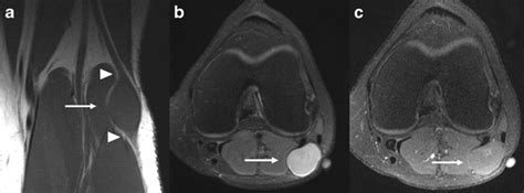 Peroneal Nerve Normal Anatomy And Pathologic Findings On Routine Mri