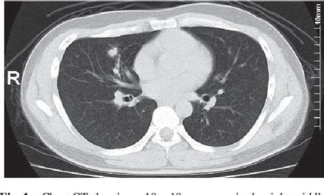 Figure 1 From Pulmonary Cryptococcosis With Eosinophilic Granuloma Of