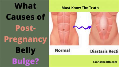Belly Bulges 7 Major Causes Of Belly Bulge And Solution Tannos Online