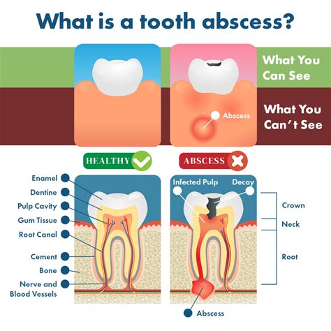 Tooth Abscess Symptoms Remedies Complications And Prevention