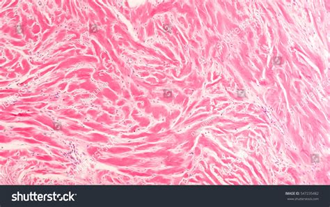 Keloid Histology Photomicrograph Keloid Scar Tissue Foto Stok 547235482