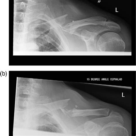 A And B Post Operative Fixation Radiographs Download Scientific