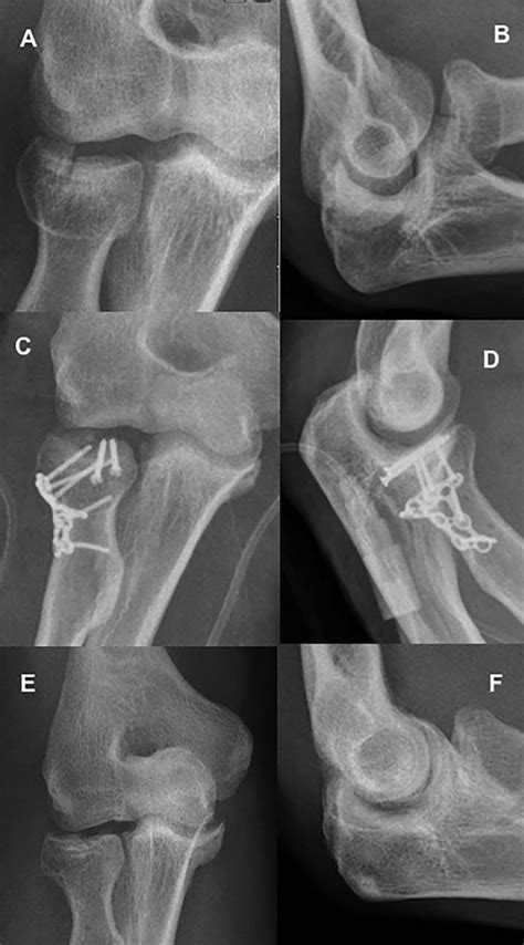 Complex Radial Head And Neck Fractures Treated With Modern Locking