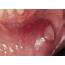 15 Oral Soft Tissue Lesions And Minor Surgery  Pocket Dentistry