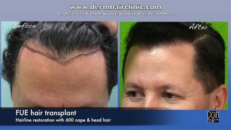 Marvelous Widows Peak Hairline Before And After Fue Info For