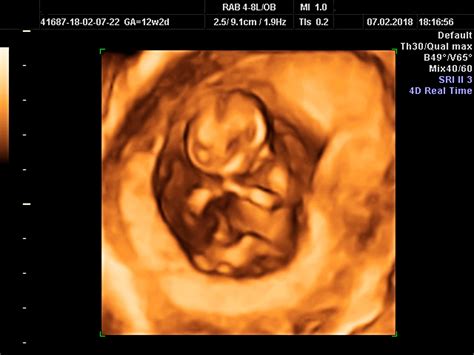12 Week Pregnancy Ultrasound