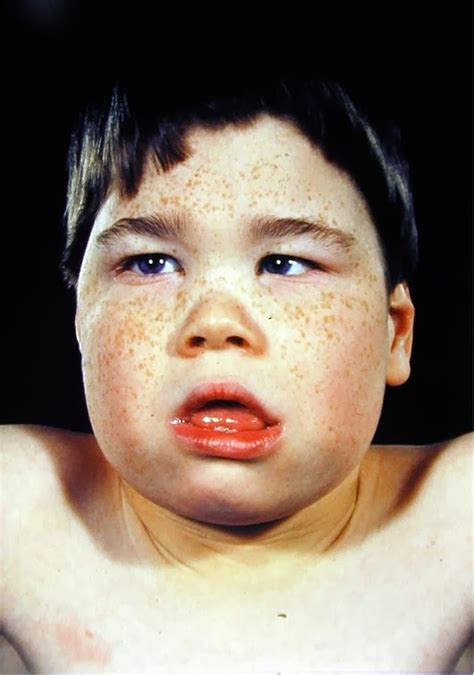 Sifats Disease Atlas Faces Of Patients In Thalassemia