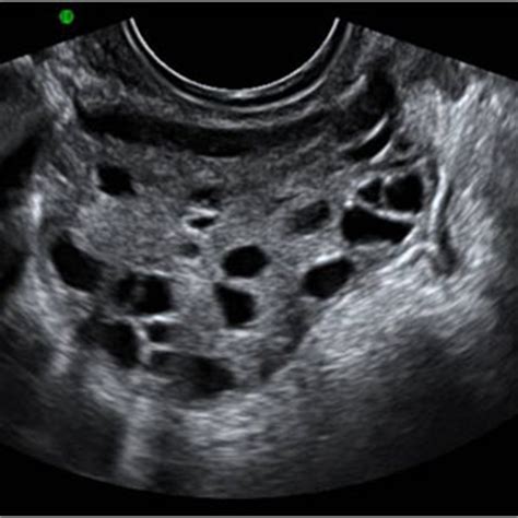 Missing a period can be a sign of something minor, or there's a small chance it could be ovarian cancer. PCOS