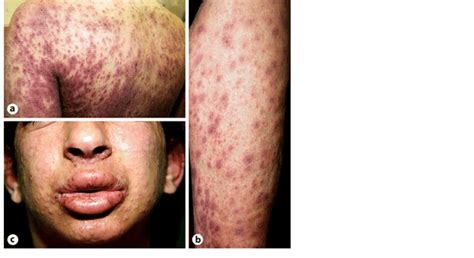 A Papular Pustular Erythema And Target Like Lesions Over The Trunk