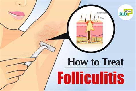 How To Get Rid Of Folliculitis Get Quick Relief With 7 Home Remedies