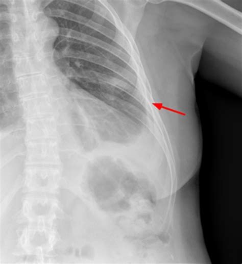 Xray View Of Female Upper Body Showing Rib Cage Spine