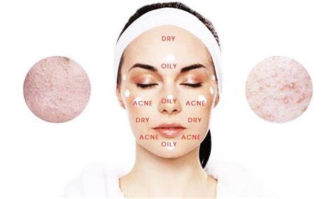 Combination Skin Treat Oily Skin Or Treat Dryness Grace Skincare Clinic