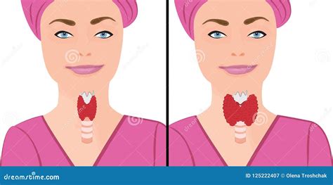 Thyroid Healthy And Enlarged Thyroid Hypothyroid Vector Illustration