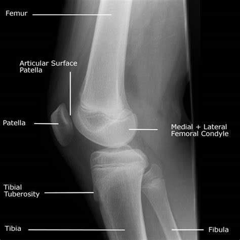 Knee Xray Displays Basic Knee Joint Anatomy Including Patella Femur