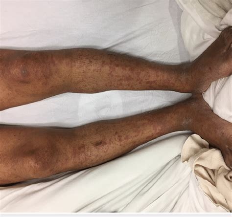 At Initial Presentation Diffuse Erythematous To Hyperpigmented Patches