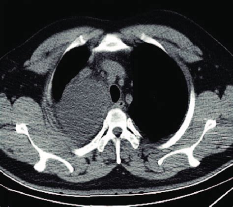 Chest Ct On June 13 Showed Enlarged Mediastinal Cyst Download
