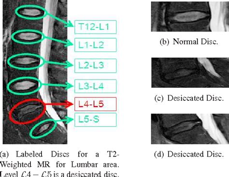 Figure 1 From Desiccation Diagnosis In Lumbar Discs From Clinical Mri